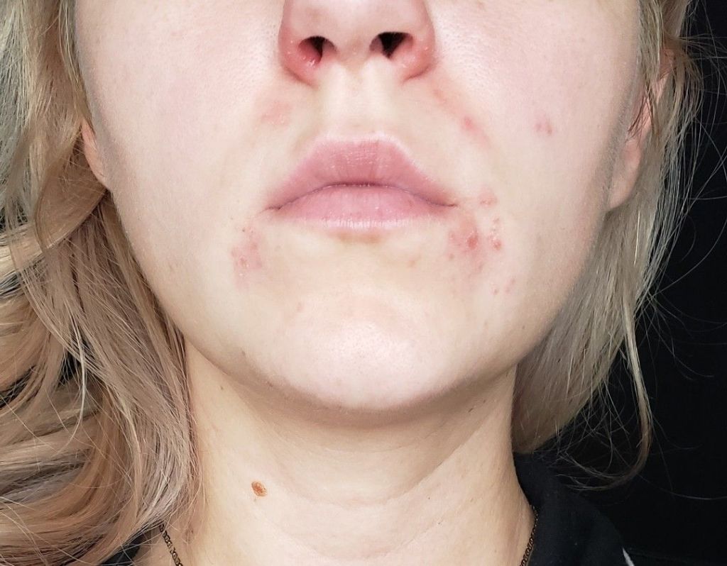 How I Cleared My Perioral Dermatitis Without Antibiotics